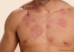 Gejala Penyebab dan Keperawatan Lupus