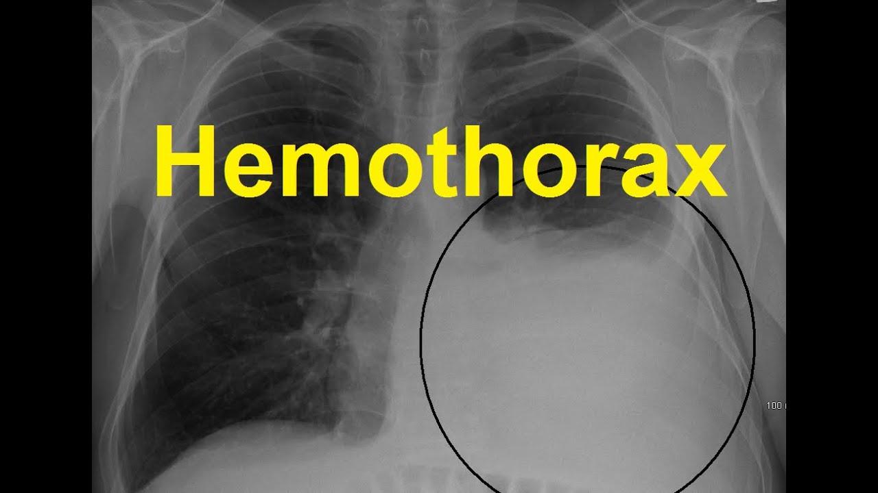 Hemothorax